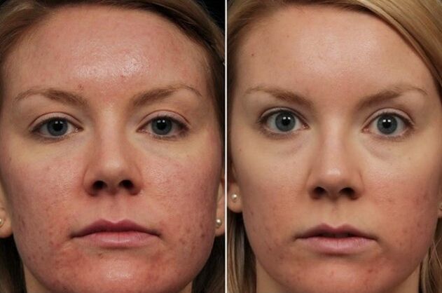 Rajeunissement au laser