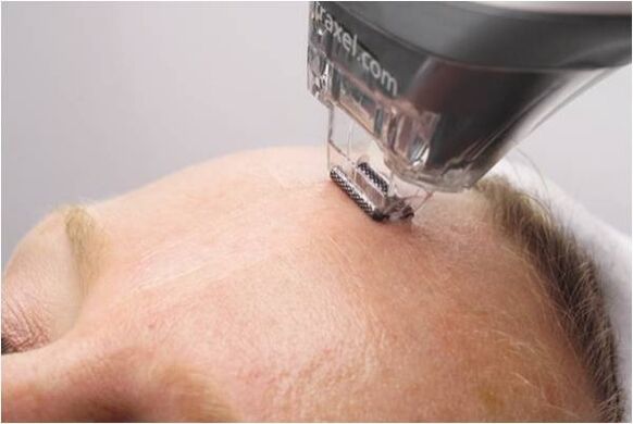 procédure de peeling pour le rajeunissement de la peau du visage